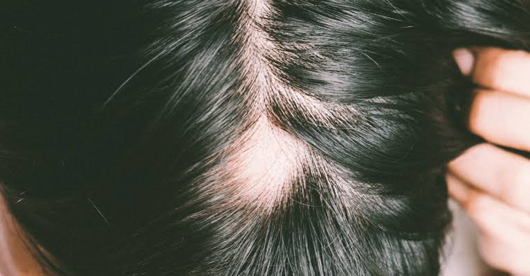 Regain Confidence with PRP Hair Loss Treatment Austin at Maverick Men’s Health Austin