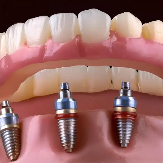 Why All-on-4 Dental Implants Offer a Stable Alternative to Traditional Dentures